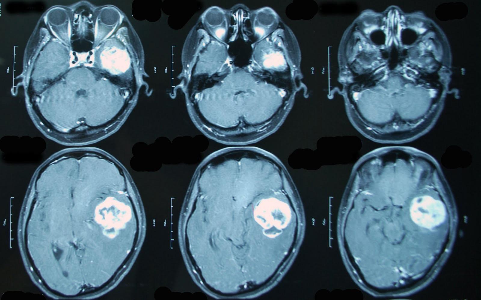 Пример МРТ снимка головного мозга с контрастом