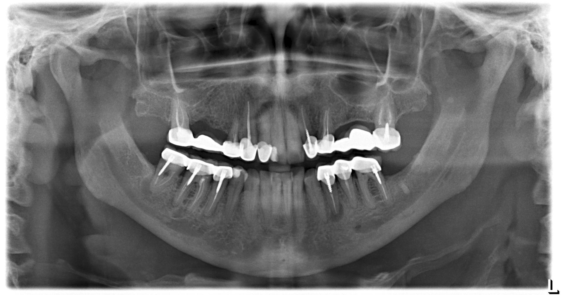 Пример МРТ снимка с металлическими зубными коронками
