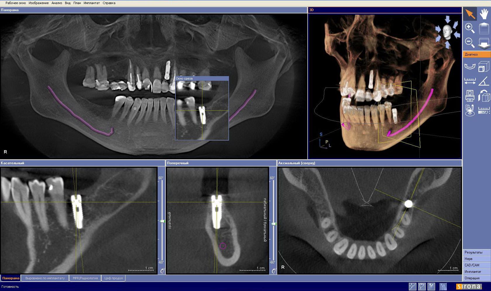 3D снимок КТ зубов