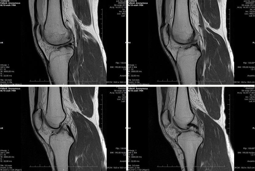 Снимок МРТ коленного сустава