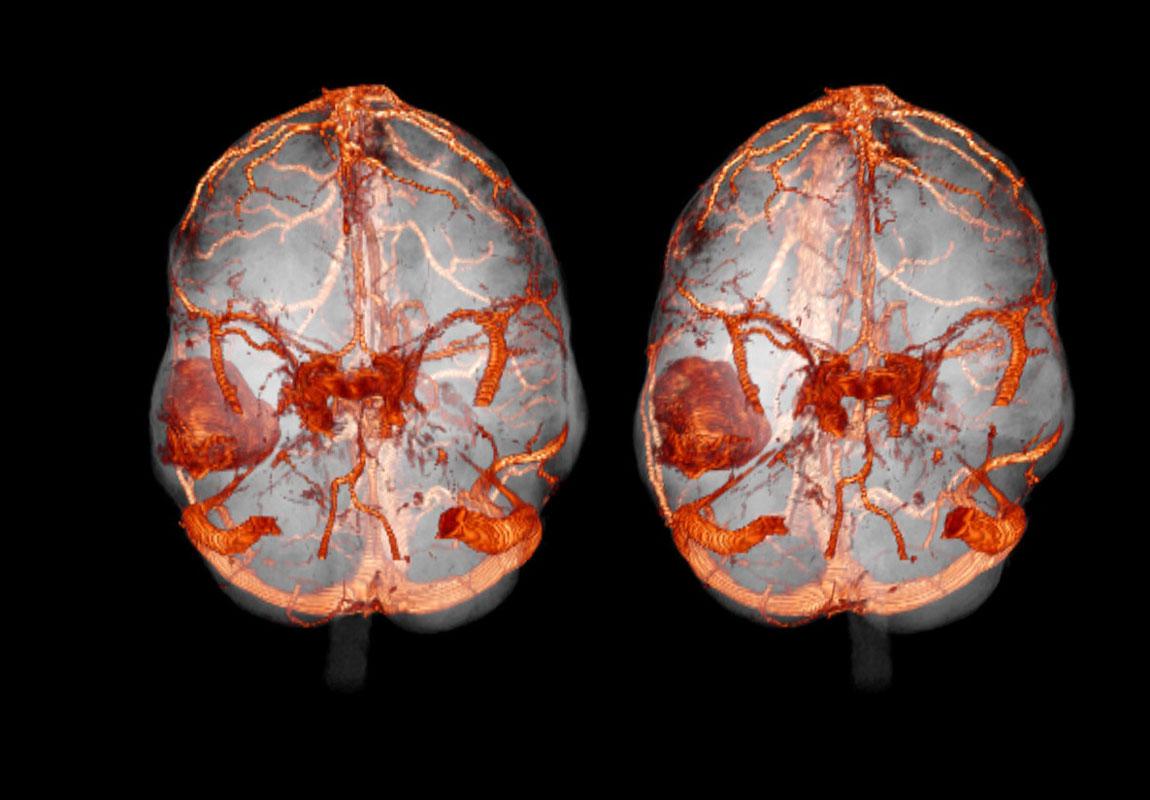 КТ снимок головного мозга с контрастированием