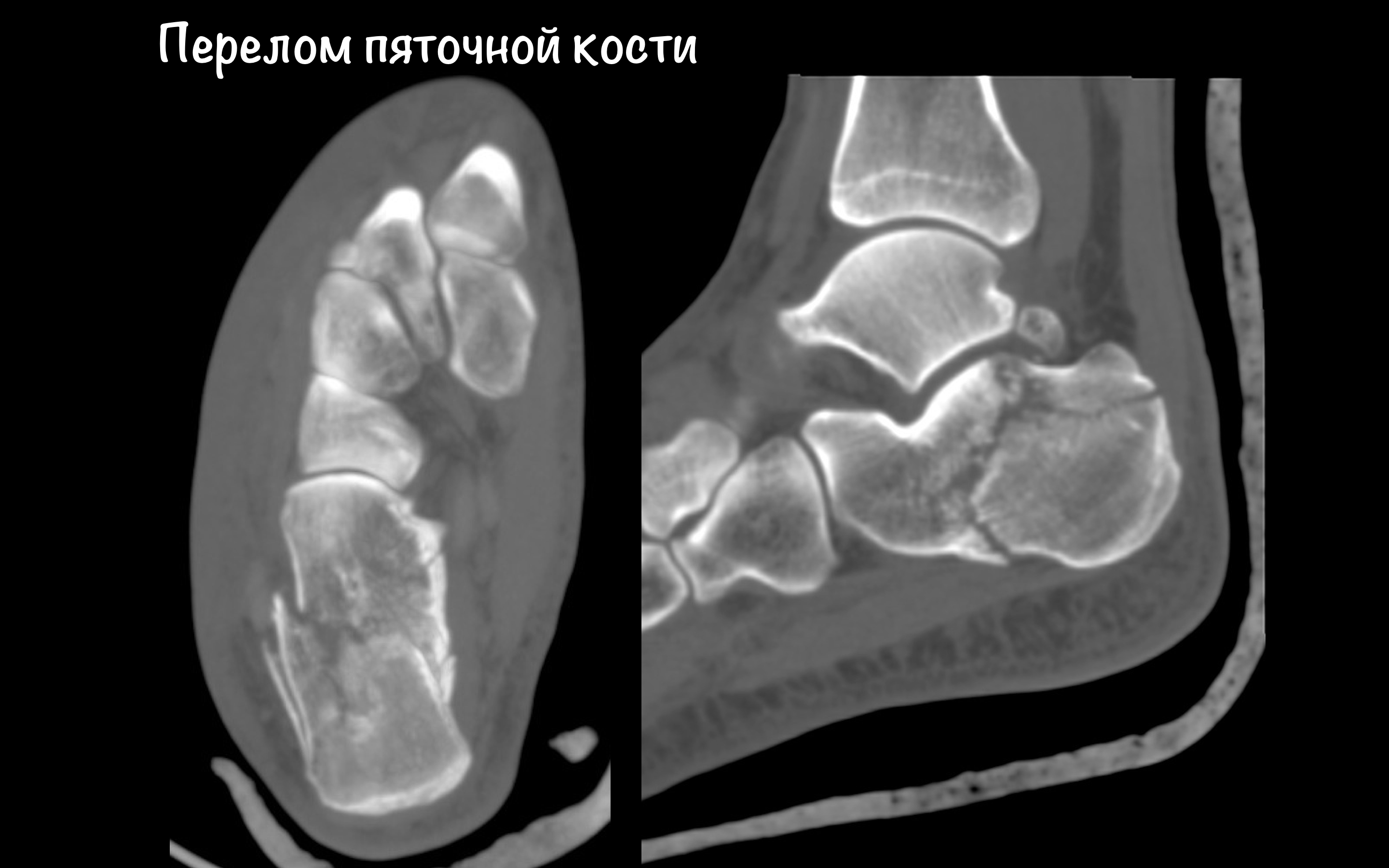Изображение - Компьютерная томография голеностопного сустава kt-golenostopnogo-sustava