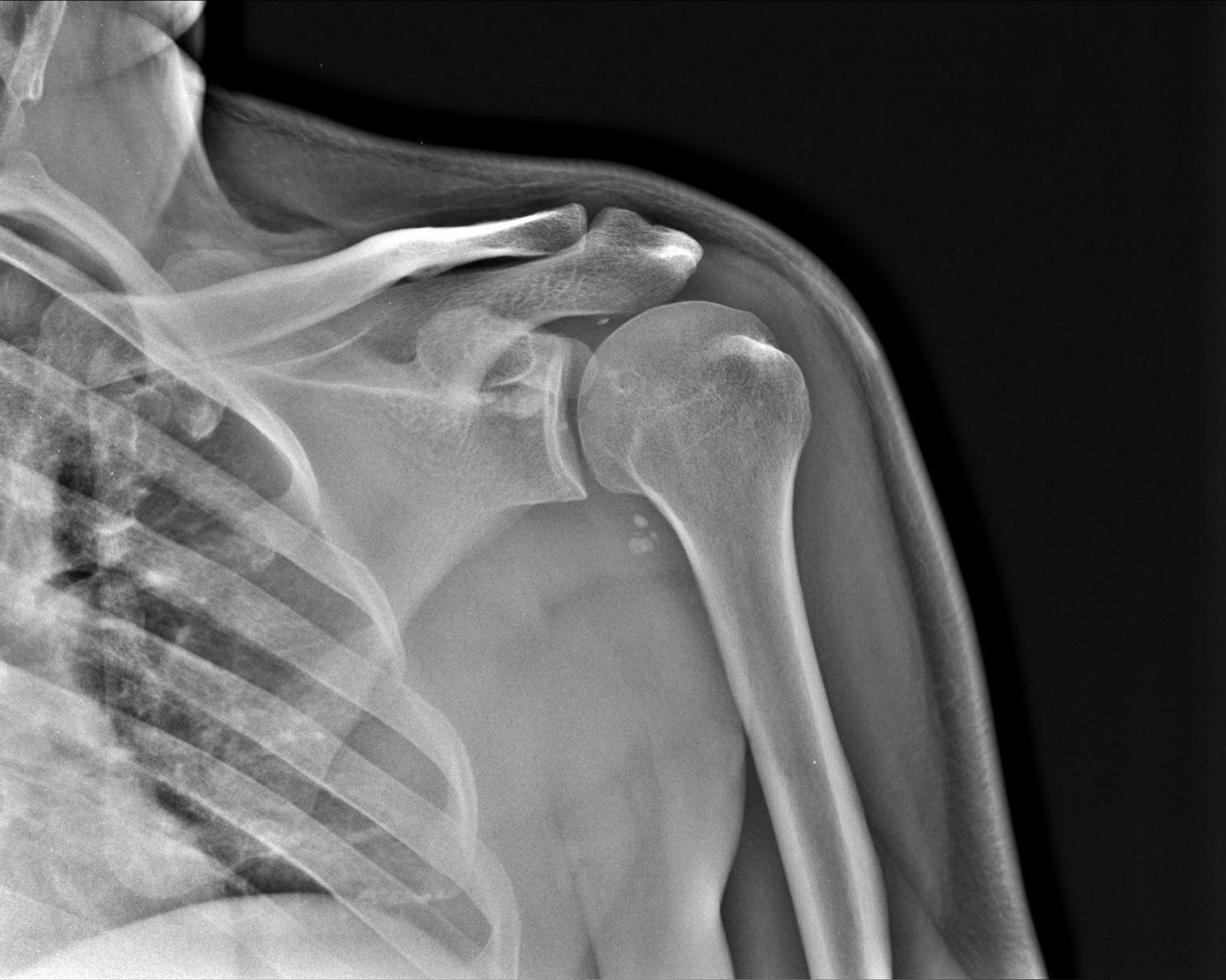 Снимок КТ плечевого сустава