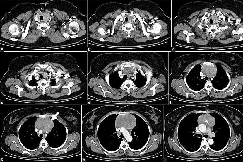 МРТ органов грудной клетки и средостения