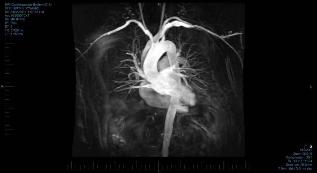 Снимок МРТ сердца и сосудов с контрастированием